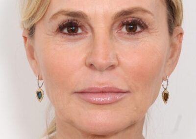 Lifting facial en Madrid