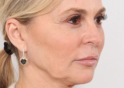 Lifting facial en Madrid