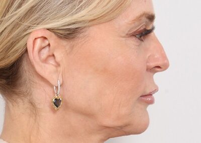 Lifting facial en Madrid