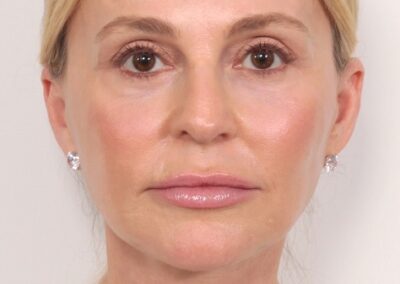 Lifting facial en Madrid
