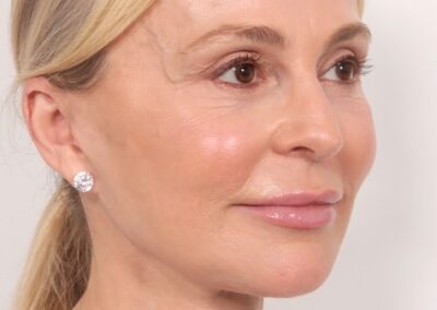 Lifting facial en Madrid