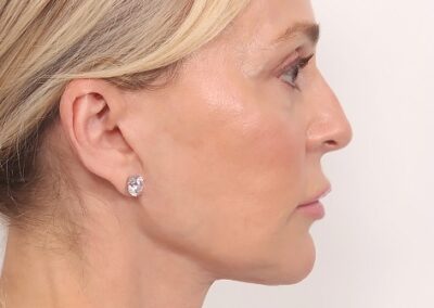 Lifting facial en Madrid