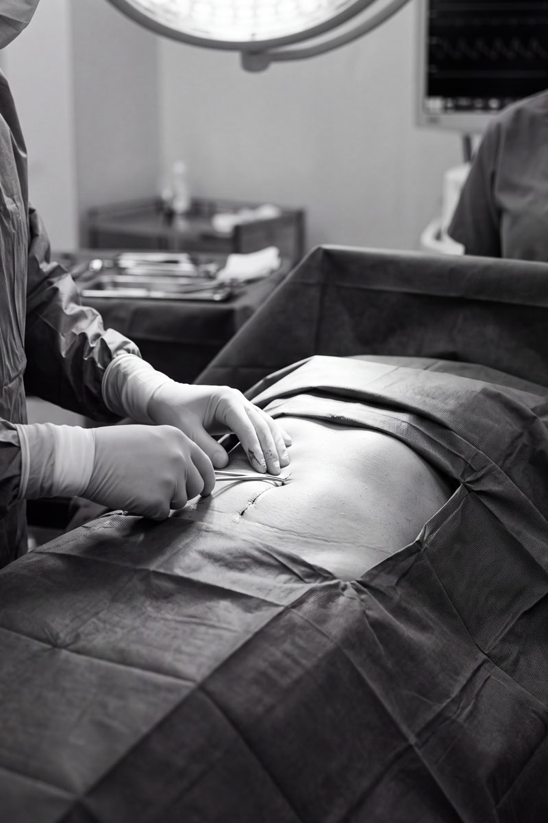 abdominoplastia Abdominoplastia en Madrid
