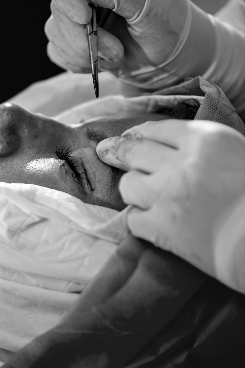 Blefaroplastia en Madrid