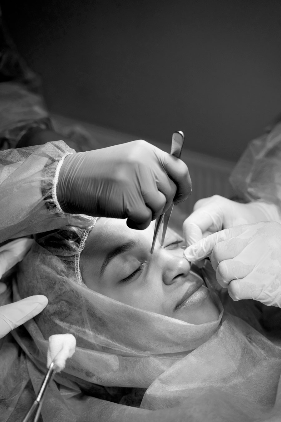 Rinoplastia cirugía estética facial en Madrid