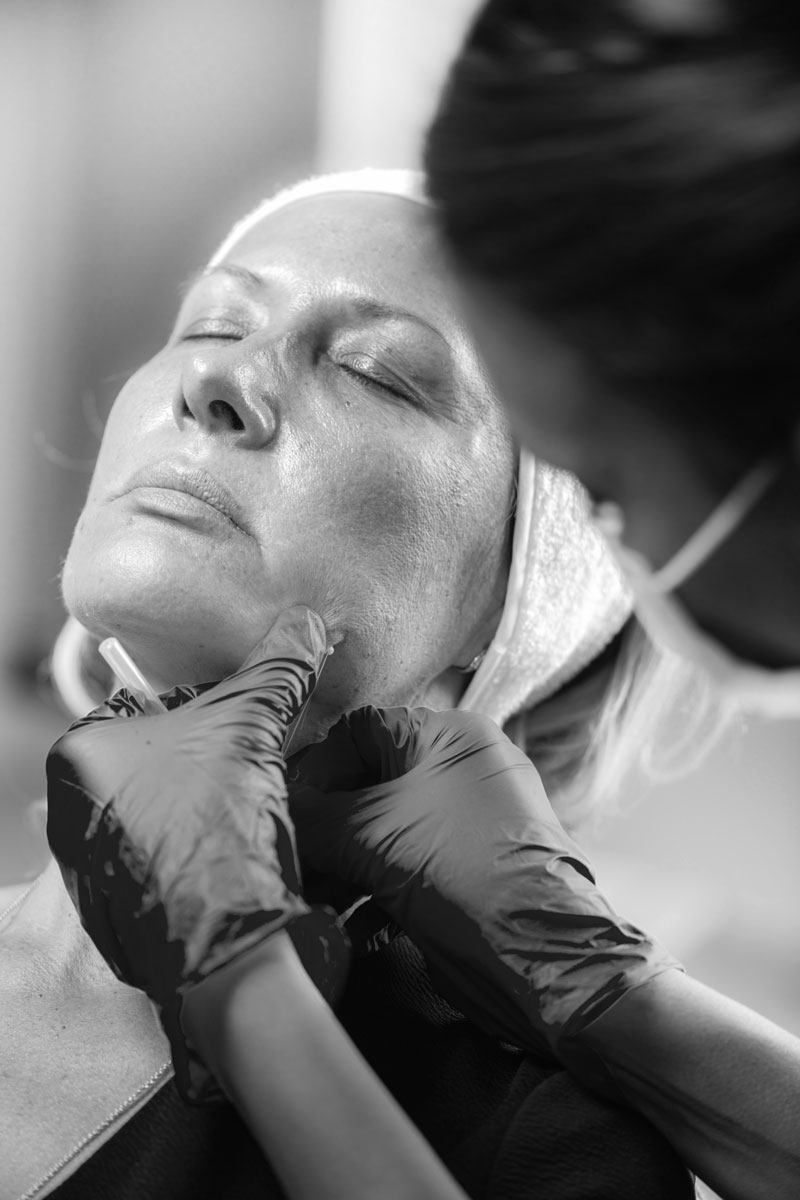 Lifting Facial en Madrid