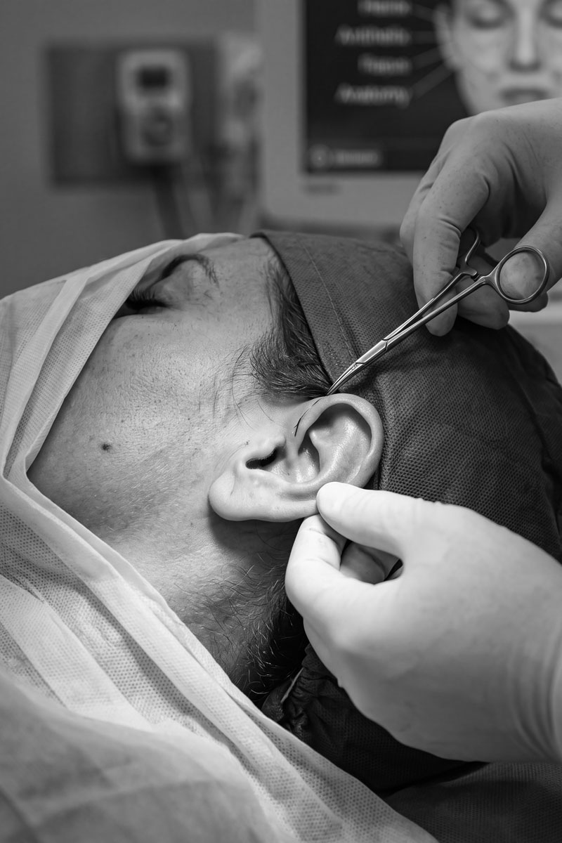 Otoplastia en Madrid