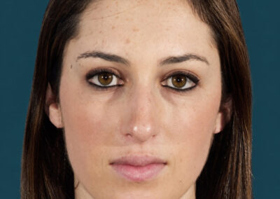 RINOPLASTIA ANTES