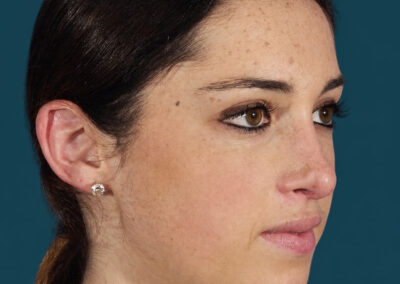 RINOPLASTIA DESPUÉS