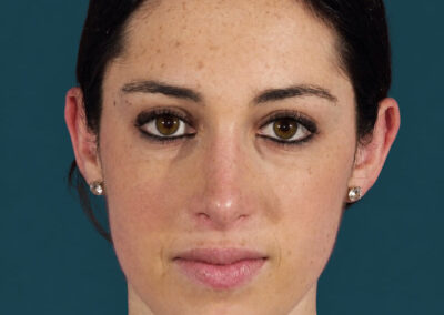 RINOPLASTIA DESPUÉS